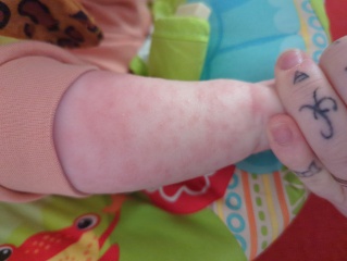 Heat rash?