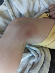 Bite (allergy)