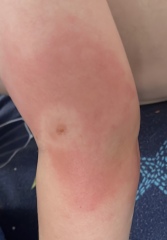 Bite (allergy)