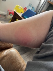 Bug bite - should I be worried???