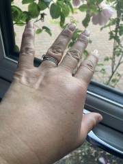 Anyone had an insect bite like this