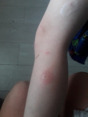 Is this normal for a bite mark? 