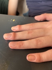 Hand and fingers all weird looking after broken wrist