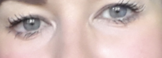 Upper Blepheroplasty