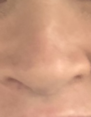 BCC on nose… surgery