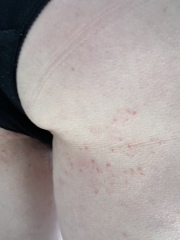 PIX  pls identify this rash on my bottom? 