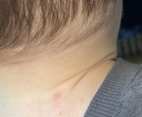Stubborn rash 