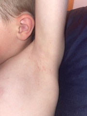 Would you be worried about this rash? 
