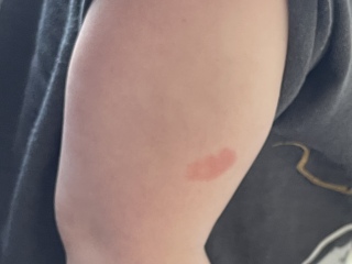 Stubborn rash 
