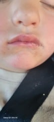 Anyone know what this might be called? Small red mark on toddlers lip?