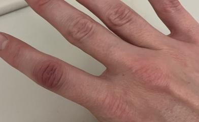 Achenbach syndrome - help, please!