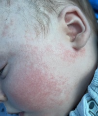 Eczema in babies - condition or symptom?