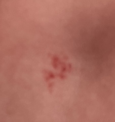 Mark on babies back birthmark or something els ?????