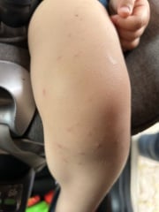 Chicken pox help ?!