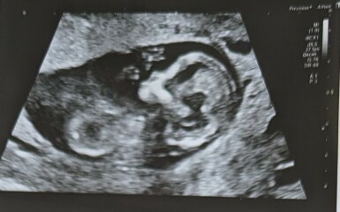 Gender guesses (scan photos included!)