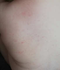 1 Year Old Rash