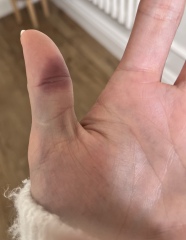 Achenbach syndrome - help, please!