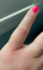 Swollen tingling hand following tiny bite or sting (pics)