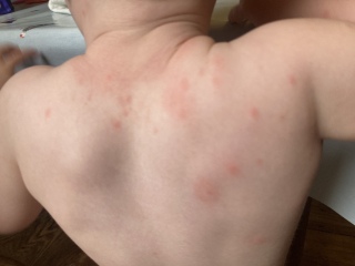 What looks like chicken pox but isn’t?