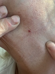 Mole fell off in my hand with picture