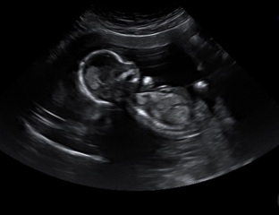 Nub theory - guess the gender!
