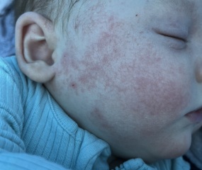 Eczema in babies - condition or symptom?