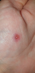 Wart help - using bazuka but it looks a bit wrong (photos)