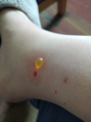 Insect bites