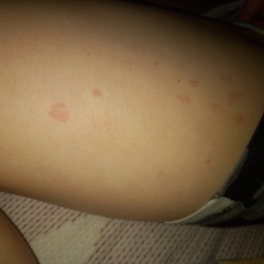 Fever and blotches on legs