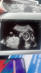 20 week scan gender guess (for fun!)
