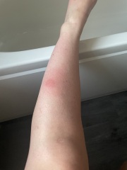 Insect bite - photos 
