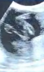 Cord or Penis 