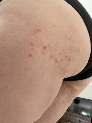 PIX  pls identify this rash on my bottom? 