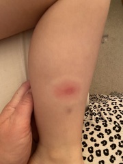 Are these tick bites?