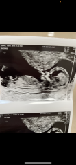 Nub theory - 13 weeks and 1 day