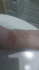 (Maybe?) Nasty bite?