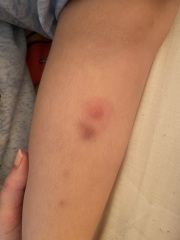 Are these tick bites?