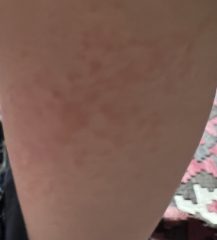 Scarlet Fever rash