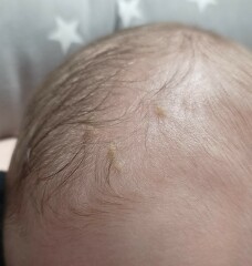 Cradle cap? 