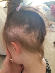 Hair loss in 4 year old
