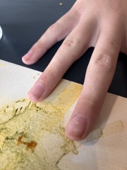 Hand and fingers all weird looking after broken wrist