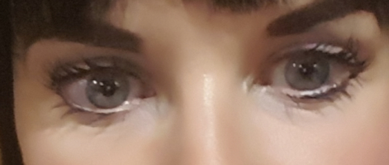 Upper Blepheroplasty