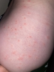 Does anyone have any idea what this rash could be?