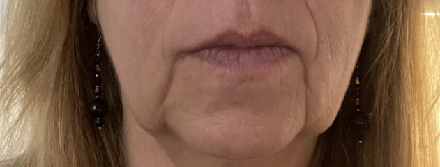 Upper Blepheroplasty