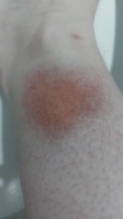(Maybe?) Nasty bite?