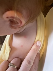 What looks like chicken pox but isn’t?