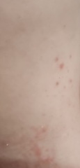 Rash around 2 Yr old waistline 