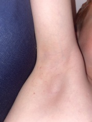 Would you be worried about this rash? 