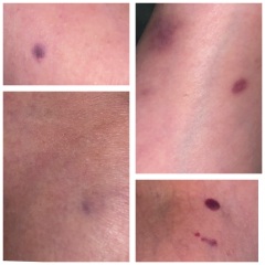 Bruising
