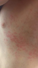 Scarlet Fever rash